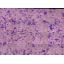 Chronic Myelocytic Leukemia (NE55 63X)